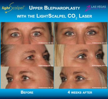 Blepharoplasty with the LightScalpel CO2 laser