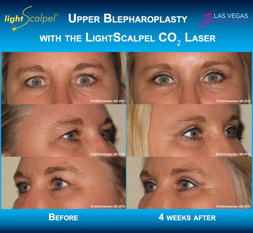 Blepharoplasty with the LightScalpel CO2 laser