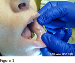 Figure 1 - Irritation Fibroma
