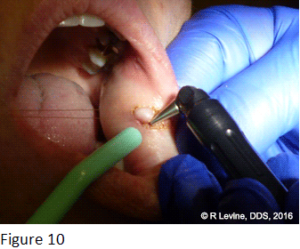 Figure 10 - Irritation Fibroma removal with CO2 Laser