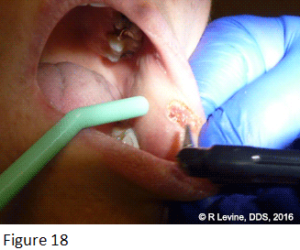 Figure 18 - Irritation Fibroma removed with CO2 Dental Laser
