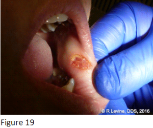 Figure 19 - Irritation Fibroma removed with CO2 Dental Laser