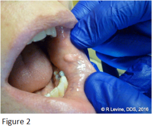 Figure 2 - Irritation Fibroma