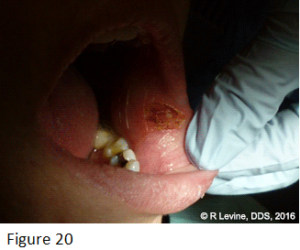 Figure 20 - Irritation Fibroma removed with CO2 Dental Laser