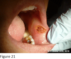 Figure 21 - Irritation Fibroma removed with CO2 Dental Laser