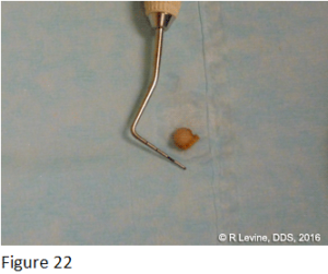 Figure 22 - - Irritation Fibroma removed