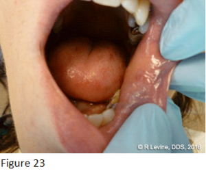 Figure 23 - Irritation Fibroma healed