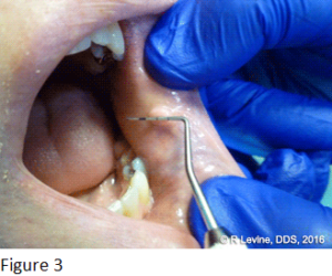 Figure 3 - Irritation Fibroma