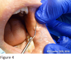 Figure 4 - Irritation Fibroma