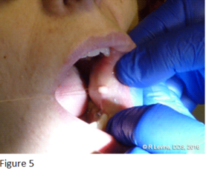 Figure 5 - Irritation Fibroma removal with CO2 Laser