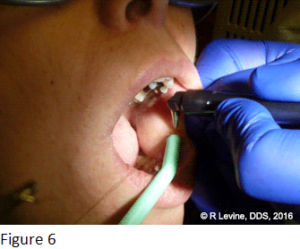 Figure 6 - Irritation Fibroma removal with CO2 Laser