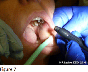 Figure 7 - Irritation Fibroma removal with CO2 Laser