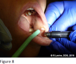 Figure 8 - Irritation Fibroma removal with CO2 Laser