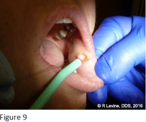 Figure 9 - Irritation Fibroma removal with CO2 Laser