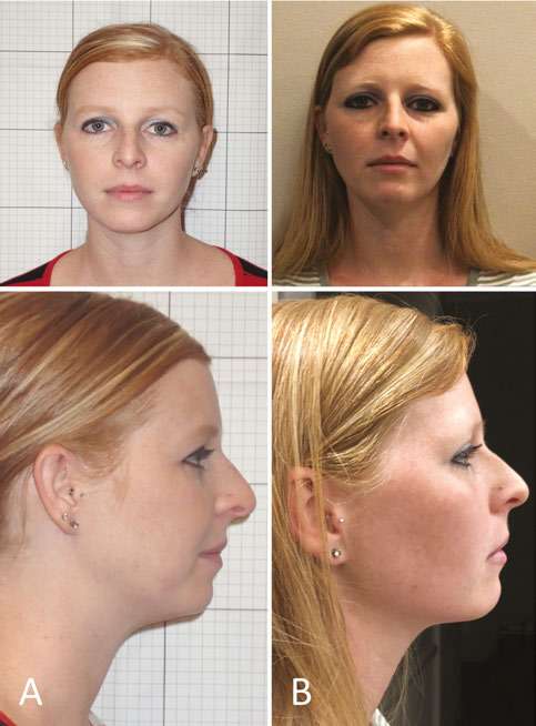 Frenuloplasty pre-treatment