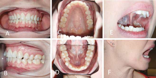 Frenuloplasty pre-treatment