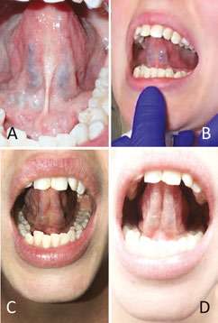 Frenuloplasty before and after photos