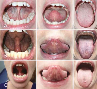 Frenuloplasty ROM muscle control photos