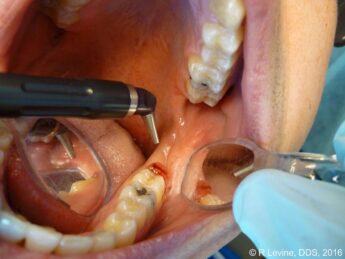 dental laser operculectomy