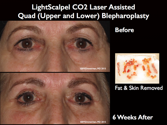 LightScalpel CO2 laser Blepharoplasty 1