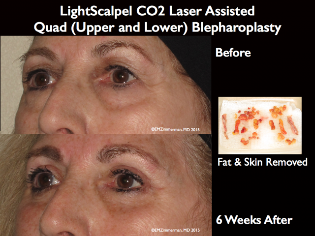 LightScalpel CO2 laser Blepharoplasty 2