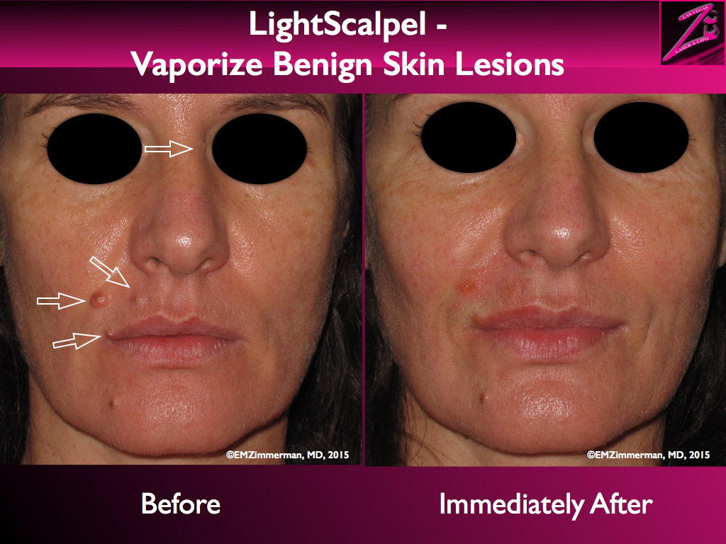 LightScalpel CO2 laser removal of benign skin lesions 1