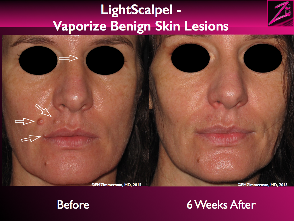 LightScalpel CO2 laser removal of benign skin lesions 2