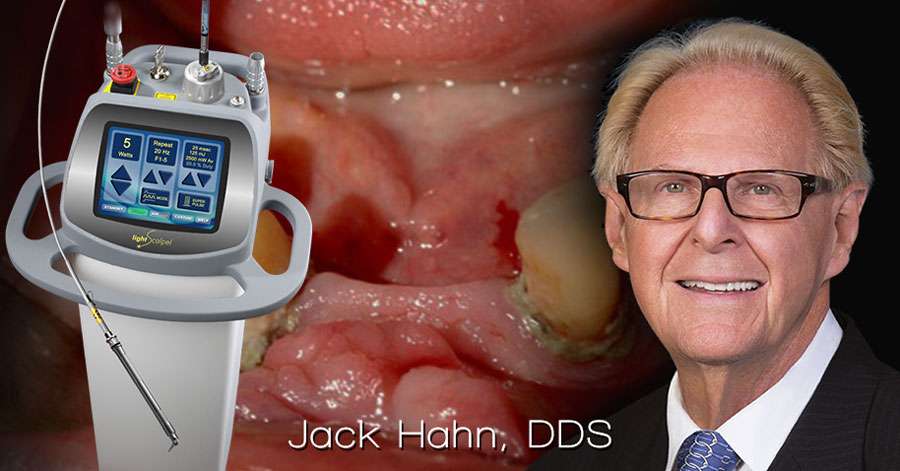 LightScalpel Laser Used to Remove Tissue Hypertrophy