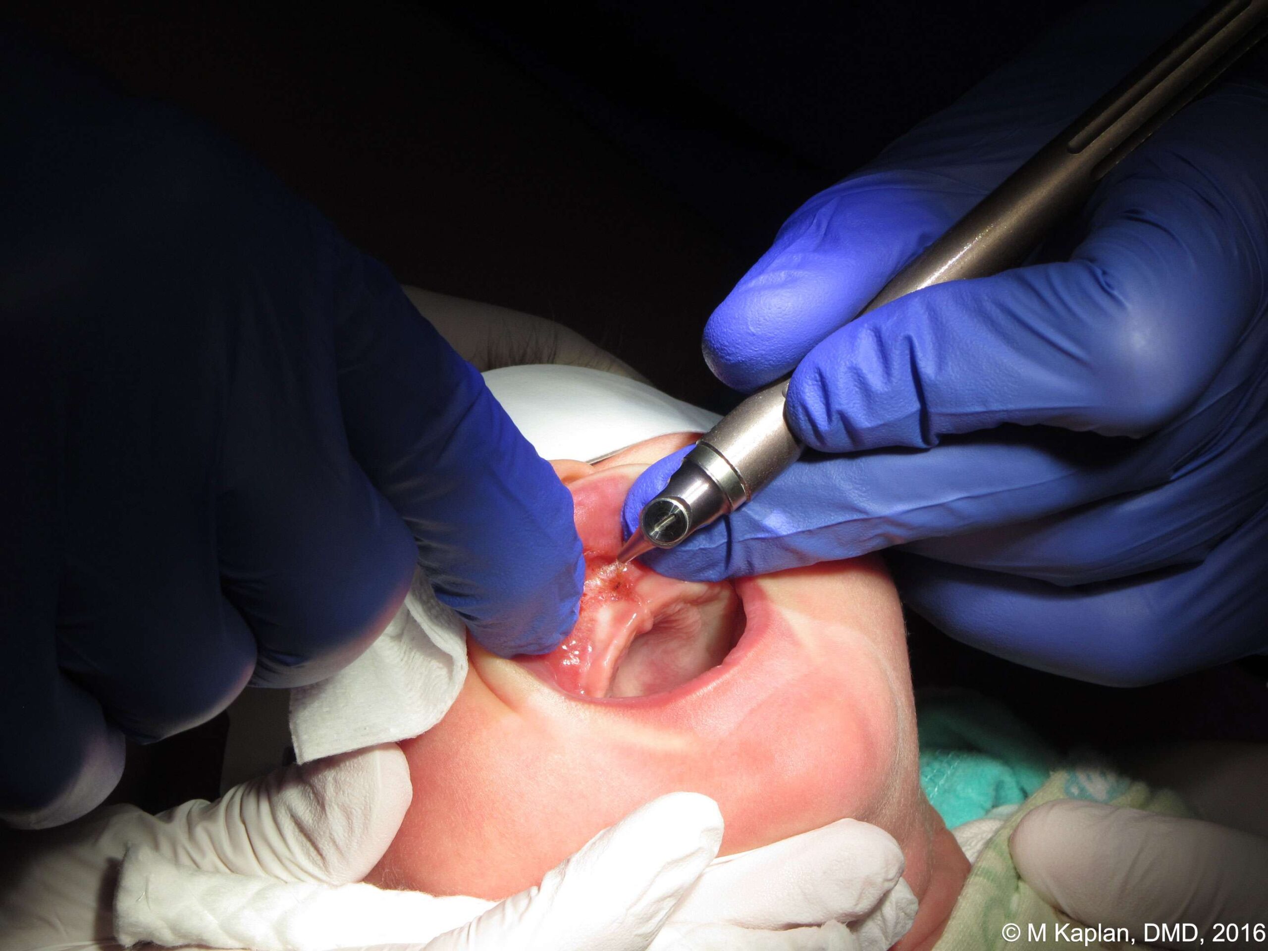 Infant Laser Frenectomy