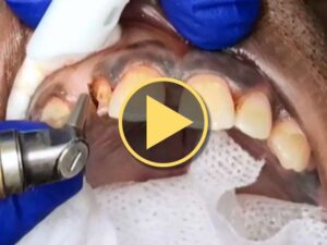 Modified Minimal Crown Lengthening Procedure - Richard Winter