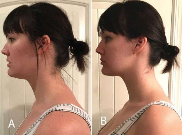 Orofacial Myofunctional Therapy 2 Posture