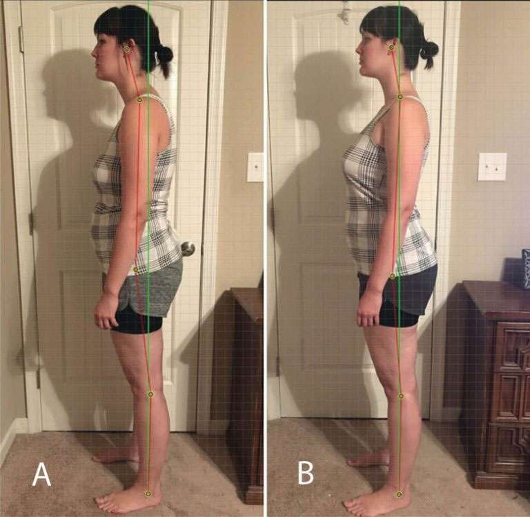 Orofacial Myofunctional Therapy 3 Posture frenectomy