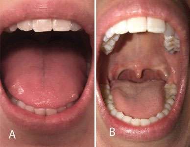 Orofacial Myofunctional Therapy 5 Mallampati score