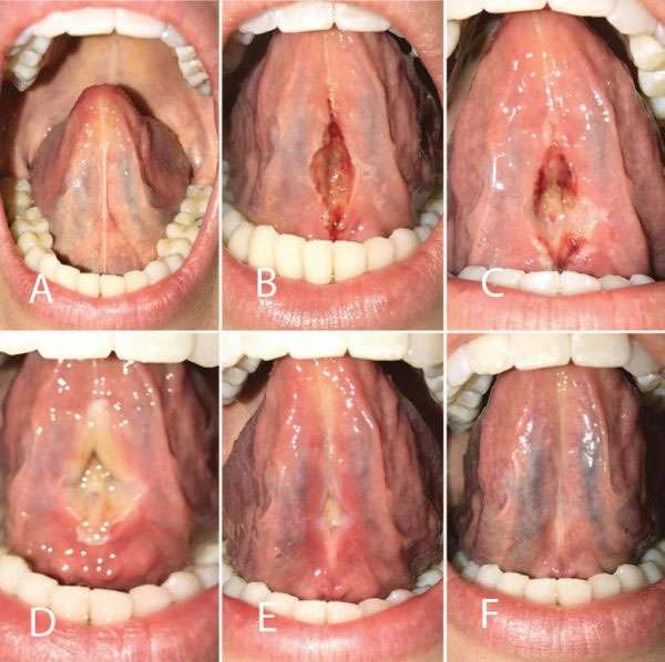 Orofacial Myofunctional Therapy 6 tongue frenectomy healing