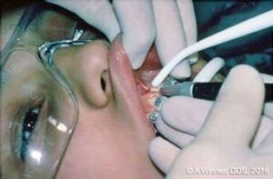 co2 laser surgery frenectomy