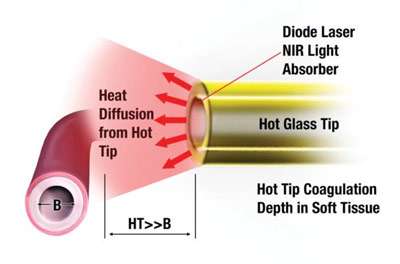 dental diode laser cutting