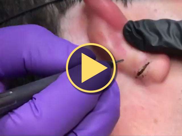 Ear lope cyst co2 laser removal video