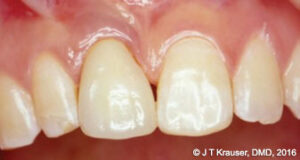 Figure 1A: 1996 image demonstrates a very good-looking implant and crown on tooth No. 8. The image was taken 3.5 months post insertion (Case courtesy of Dr. K.B. Park)