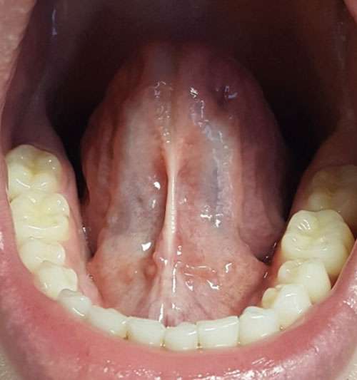 tongue tie before frenectomy