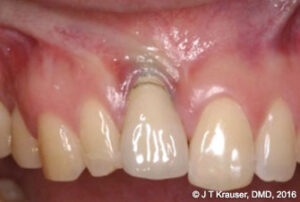 Figure 1B: 2007 view of the same. Note significant tissue recession and distinct frenum pulls (Courtesy of Dr. K.B. Park)