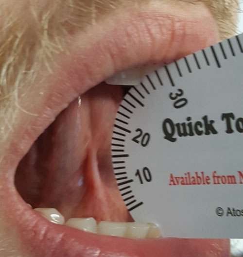 ongue-to-Spot distance preoperatively – 27 mm