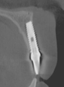 Figure 1C: 2007 cross-sectional image of the lack of bone in the facial and apical aspect of the implant. Perhaps a prophylactic release of the frenum pull would have prevented this outcome (Courtesy of Dr. K.B. Park)