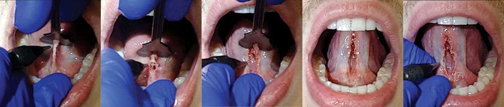 co2 laser frenectomy sequence
