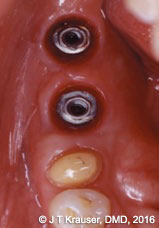 Figure 2: Occlusal view of a Brånemark implant site at close to 15 years’ placement. Note the buccallingual ridge narrowing. This, coupled with frenum pull, may contribute to a buccal recession
