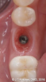 Figure 3: Occlusal view of a modern design implant Megagen AnyRidge® with its early maintenance of the buccal-lingual ridge form
