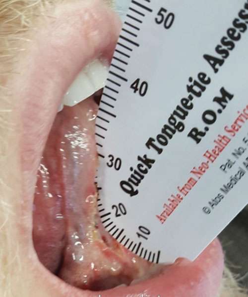 tongue to spot distance post-op