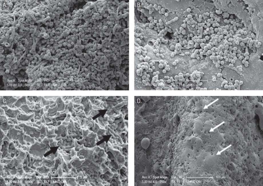 Figures 3A-3D: High magnification SEM photographs. 3A. 72-hour in vitro biofilm growth on SA implant surface (Average thickness of biofilm for all implant specimens was ≈ 10 μm with a range of ≈ 5-15 μm. Original magnification x5,000; bar = 5 μm). 3B. HA implant surface showing residual microbes following laser treatment using a fluence of 14 J/cm2 per pass of the laser beam. Original magnification of 4,000x; bar = 5 μm. 3C. PTO implant surface following laser treatment using a fluence of 14 J/cm2 per pass of the laser beam. Arrows indicate residual cocci and short rod microbes lying within surface depressions. Original magnification of 5,000x; bar = 5 μm. 3D. HA plasma-sprayed coated implant surface exhibiting evidence of surface melting (arrows) following treatment using a fluence of 38 J/cm2 per pass of the laser beam. Original magnification of 250x; bar = 100 μm