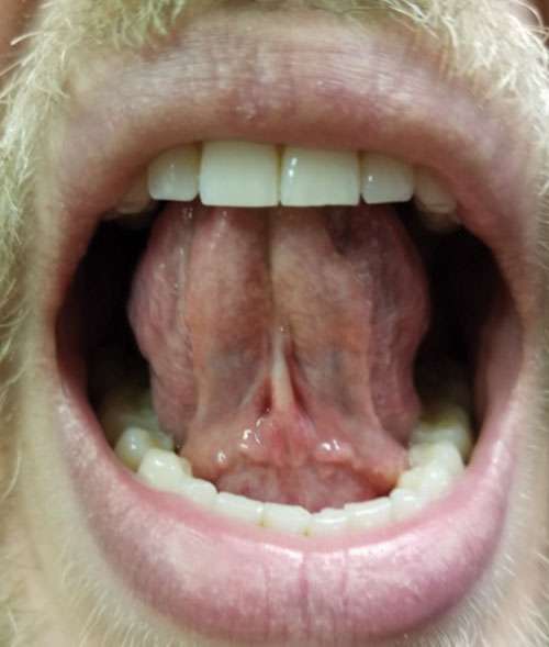 frenectomy 6 months post-op