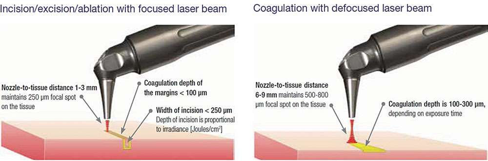 co2 laser incision and coagulation
