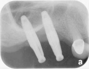 Figure 5: Pre-op X-rays showing the presence of peri-implantitis with bone loss